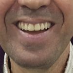 filipe-ferreira-implantologia-5-6